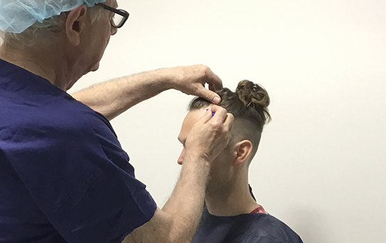 fue hair transplant