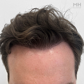 After Hair Transplant