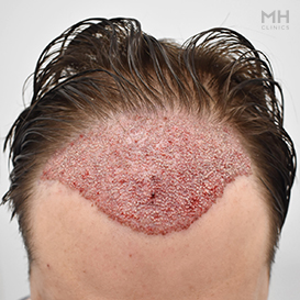 Before Hair Transplant