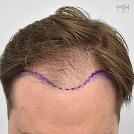 Before Hair Transplant