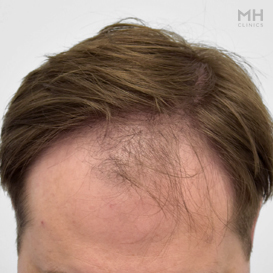 Before Hair Transplant