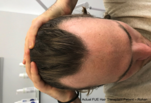 Actual FUE Hair Transplant Patient – Rohan 